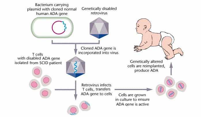 المعالجة الجينية لمتلازمة نقص المناعة الشديد