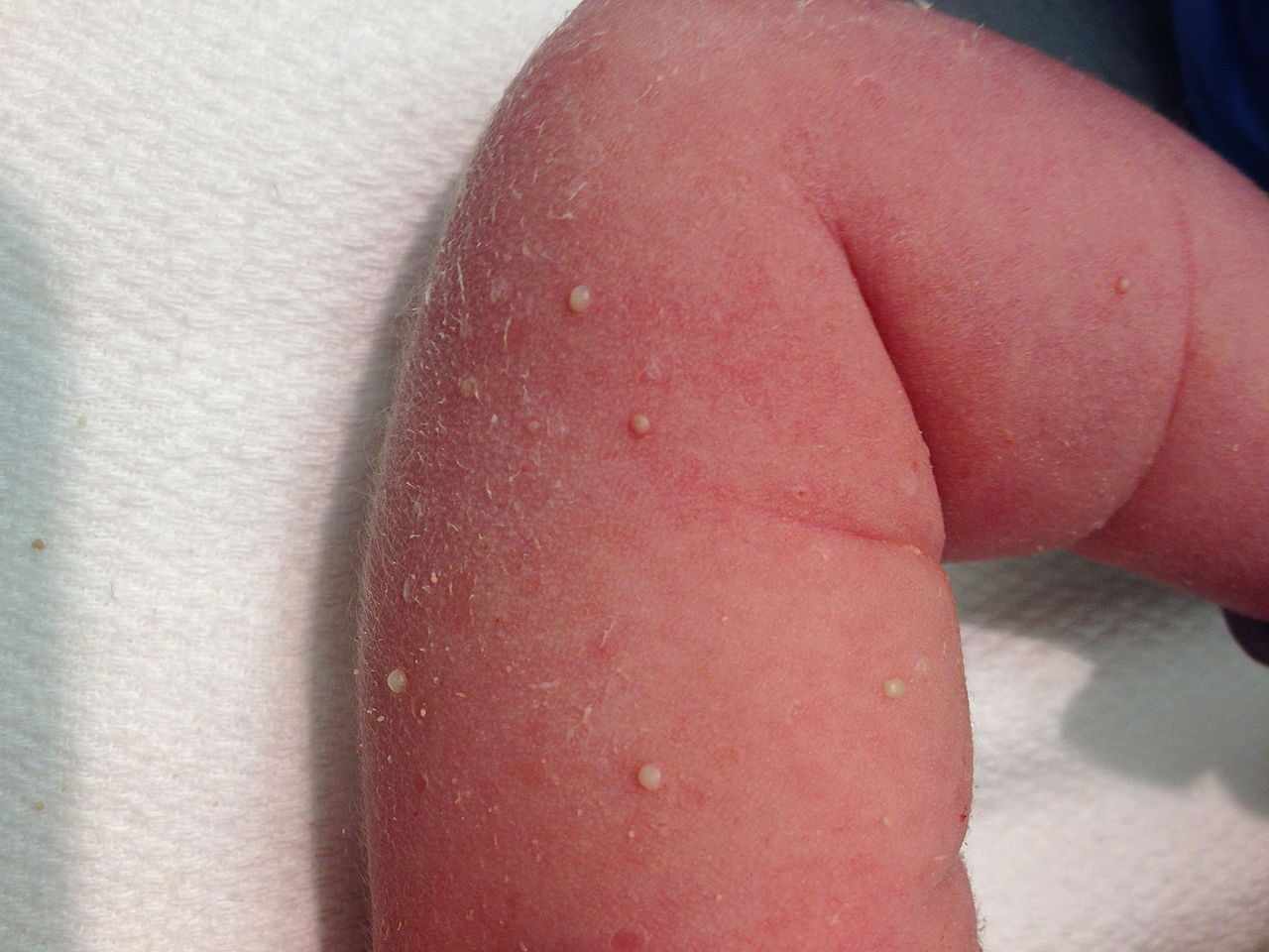 الملان البثري العابر عند حديث الولادة"Transint Neonatal Pustular Melonsis"