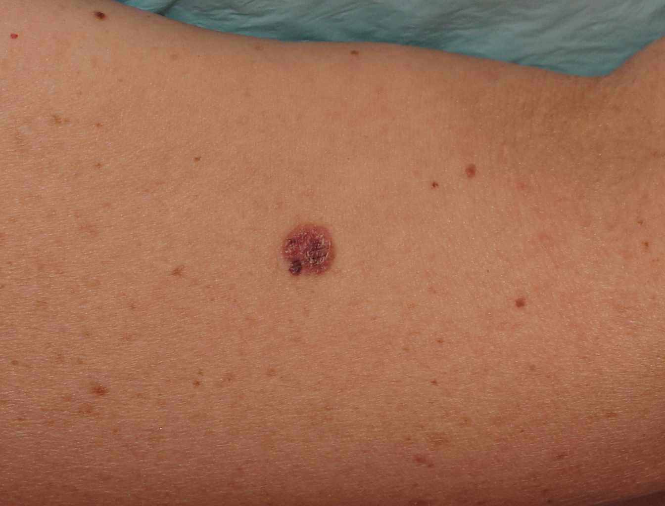 الميلانوما السرطانية عند الأطفال "Melanoma"