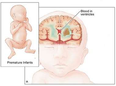 النزيف داخل البطينات الدماغية عند الطفل الخديج