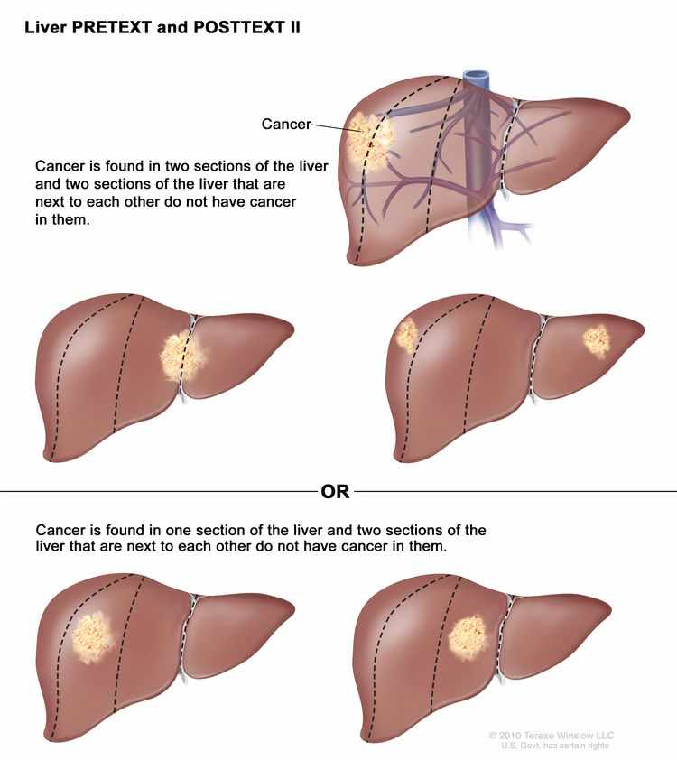 الورم الأرومي الكبدي هيباتوبلاستوما عند الاطفال