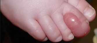 الورم الليفي الإصبعي عند الرضيع