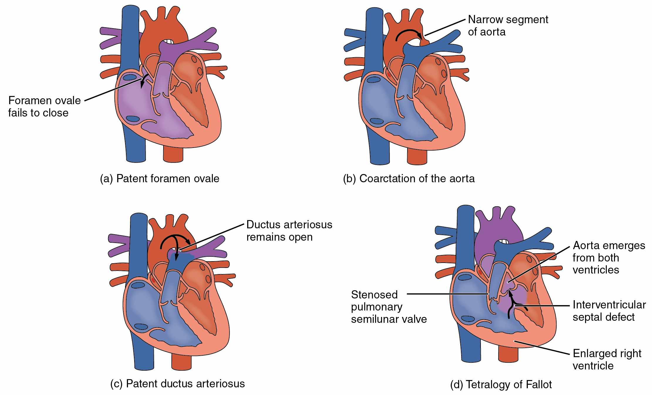 امراض القلب الولادية الخلقية للاطفال
