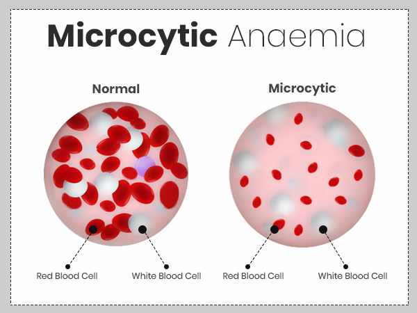 انيميا صغر حجم كريات الدم