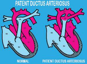 بقاء القناة الشريانية سالكة عند الطفل حديث الولادة