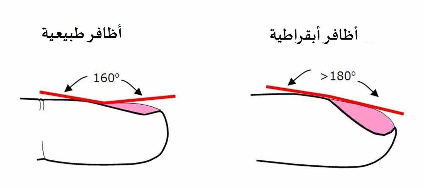 تبقرط الأظافر