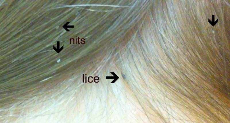 تشخيص قمل الشعر