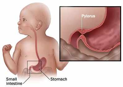 تضيق بواب المعده عند الرضع