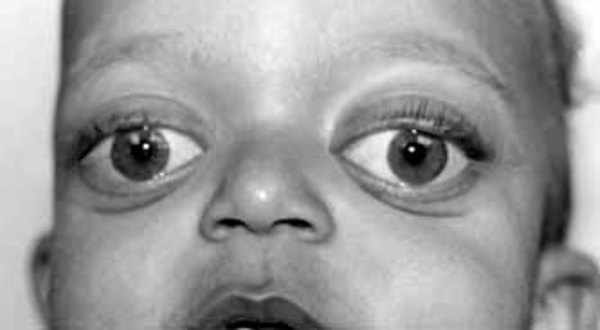 جحوظ العين عند الاطفال و الرضع