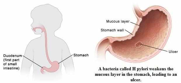 جرثومة المعدة عند الاطفال