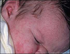 جلد الطفل عند ولادته