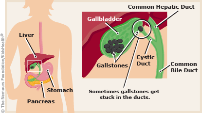 حصوة المرارة عند الاطفال