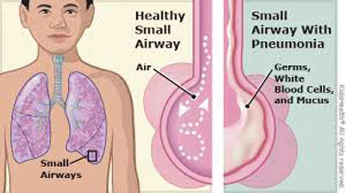 ذات الرئة عند الاطفال و الرضع