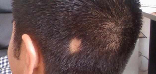 سبب حدوث الحاصة البقعية