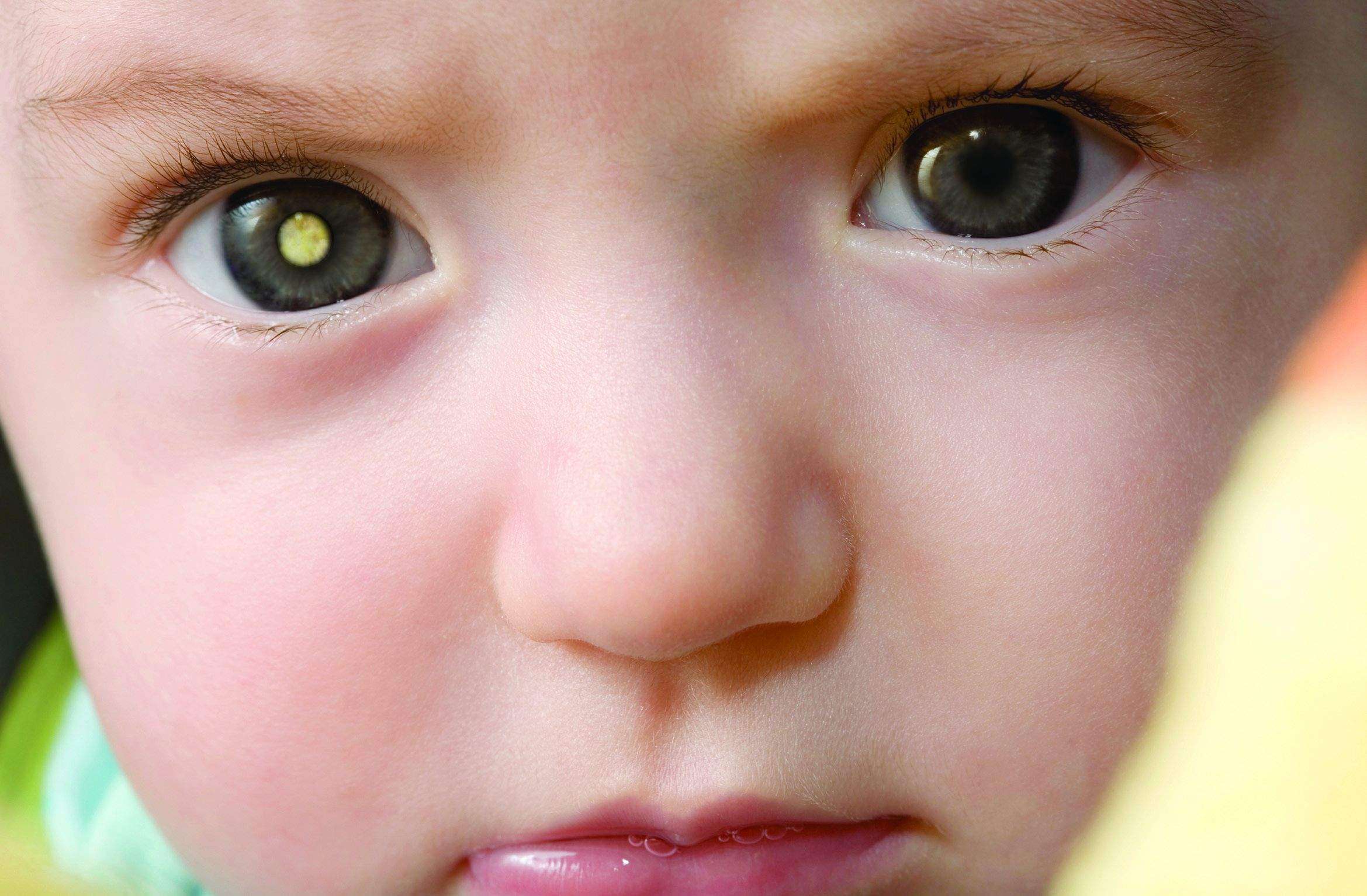 سرطان العين عند الاطفال و الرضع