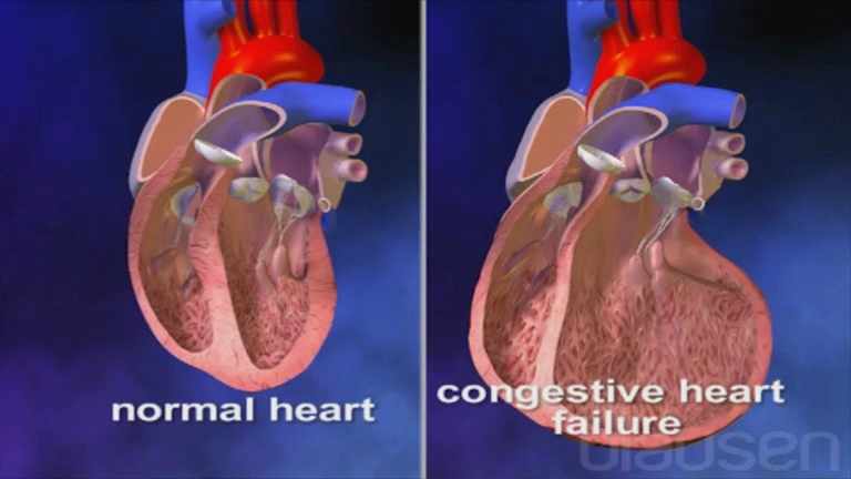 ضعف و هبوط عضلة القلب عند الاطفال و الرضع