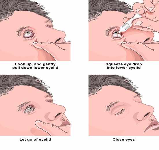 طريقة وضع قطرة العين للأطفال