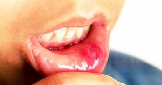 علاج التهاب الفم القلاعي