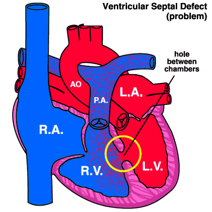 فتحة القلب بين البطينين عند الاطفال