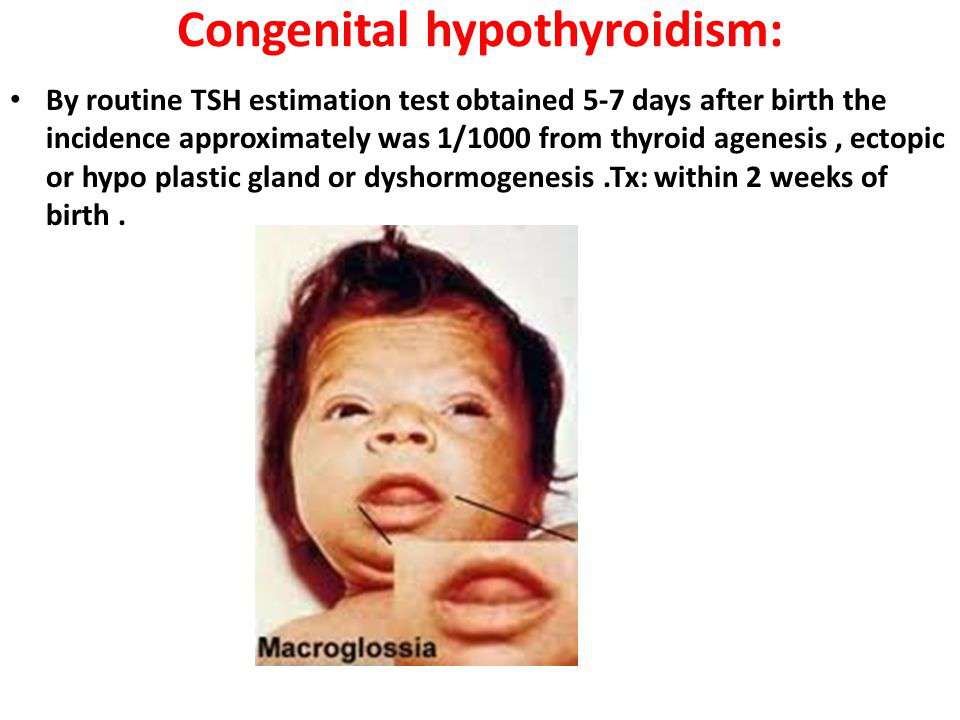 فشل الغدة الدرقية منذ الولادة عند الأطفال حديثي الولادة
