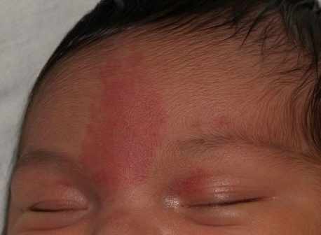 لطخة سالمون (الوحمة البسيطة) (Salmon Patch (Nevus Simplex