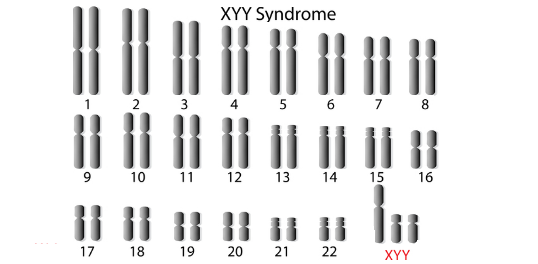 متلازمة XYY
