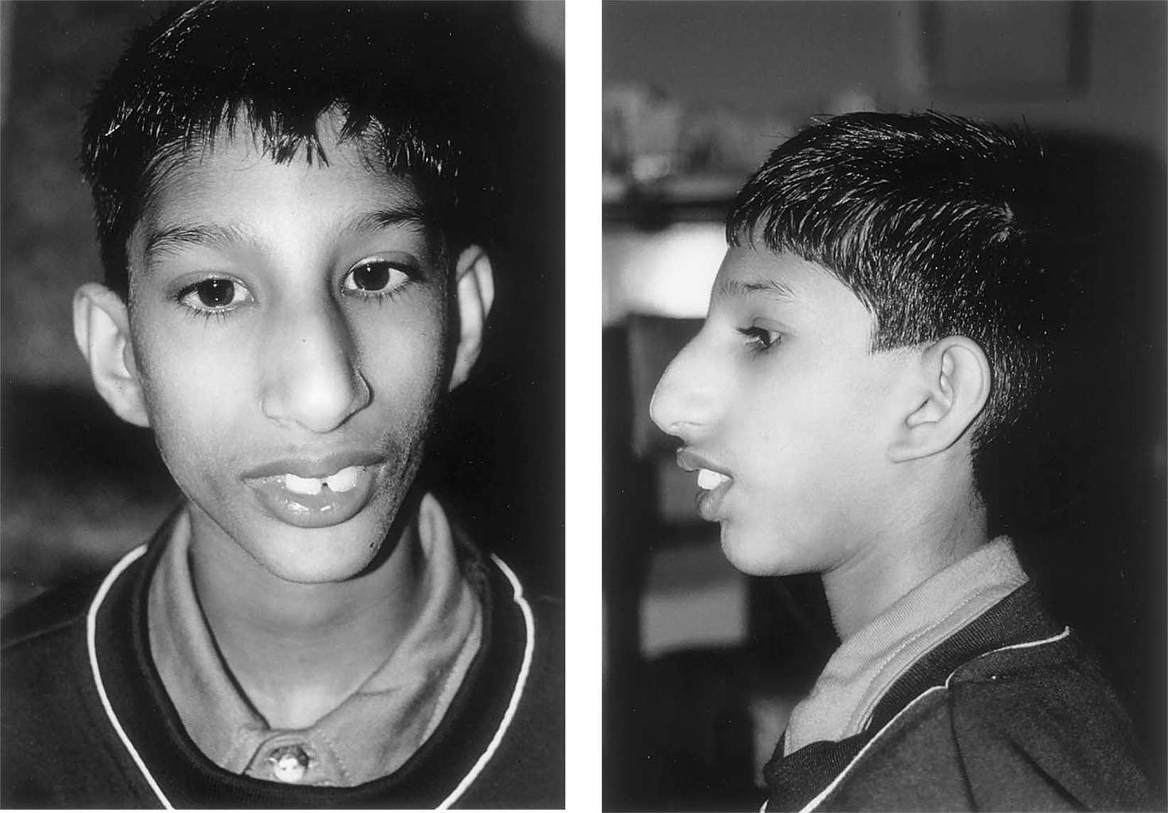 متلازمة سيكل - seckel syndrome