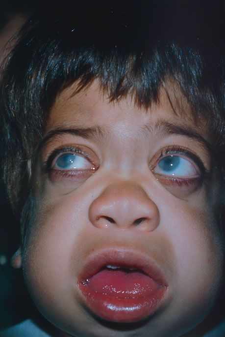 متلازمة هيرلر