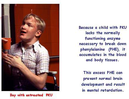 مرض الـ PKU
