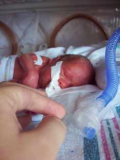 علاج استنشاق العقي عند الطفل حديث الولادة