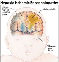 نقص الأوكسيجين عند حديثي الولادة