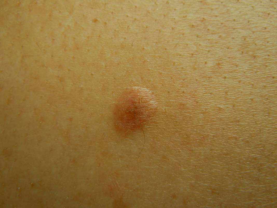 وحمة أو شامة خلايا الميلانين المكتسبة بعد الولادة"Acquired Melanocytic Nevus"