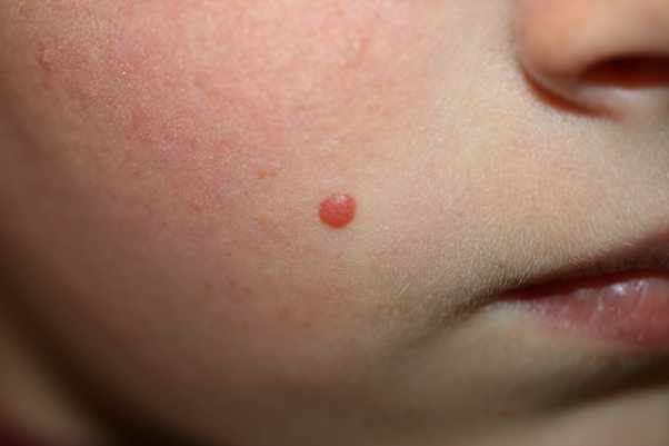 وحمة او شامة سبيتز "Spitz Nevus"