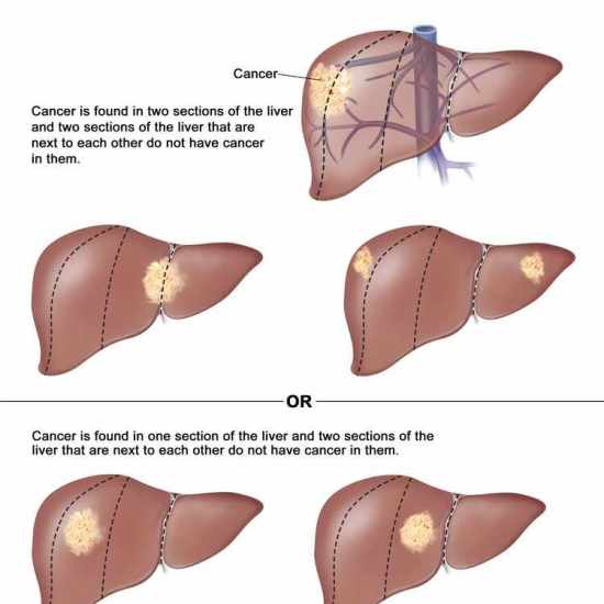 الورم الأرومي الكبدي هيباتوبلاستوما عند الاطفال