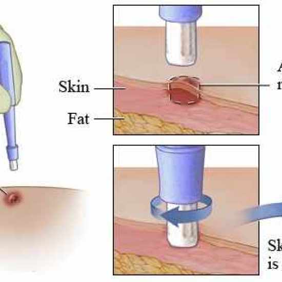 خزعة الجلد "Biopsy Of Skin"