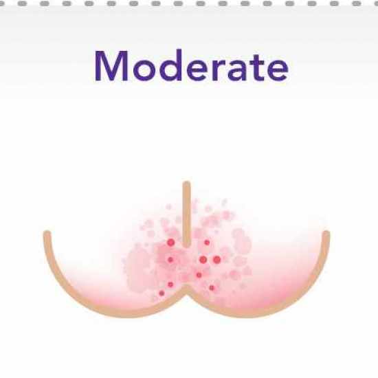 فطريات المؤخرة حول الشرج