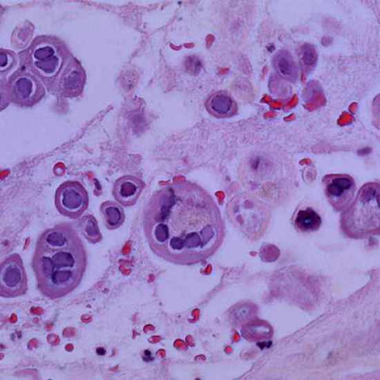 لطاخة تزانك "Tzanck Smear"