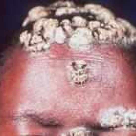 مرض المبيضات البيض المخاطي الجلدي المزمن