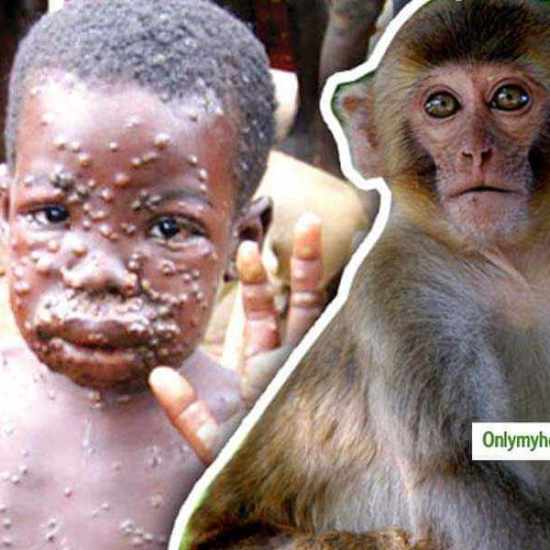 مرض جدري القرود