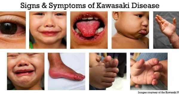 اعراض مرض كاواساكي عند الاطفال