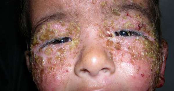 التهابات الجلد البكتيرية عند الاطفال