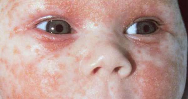 التهاب الجلد الدهني عند الأطفال و الرضع