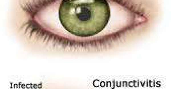 التهاب العين و الملتحمة للاطفال