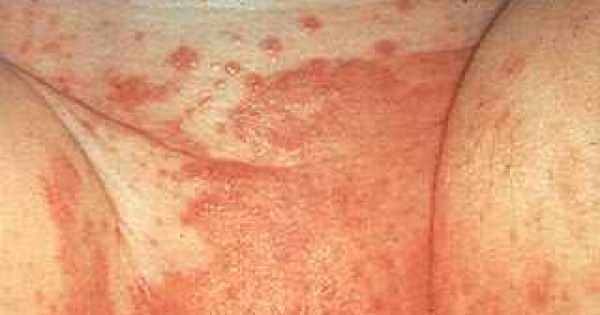 التهاب جلد الحفاظ تحت الفوطة