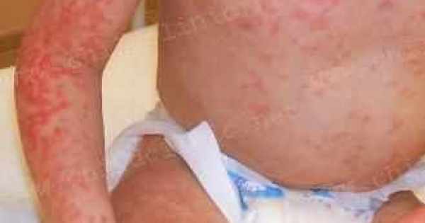 التهاب جلد نهاية الأطراف الحطاطي عند الاطفال