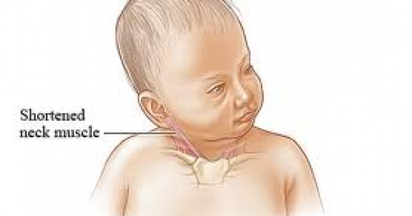 الصعر و ميلان رأس الطفل حديث الولادة نحو احد الجانبين
