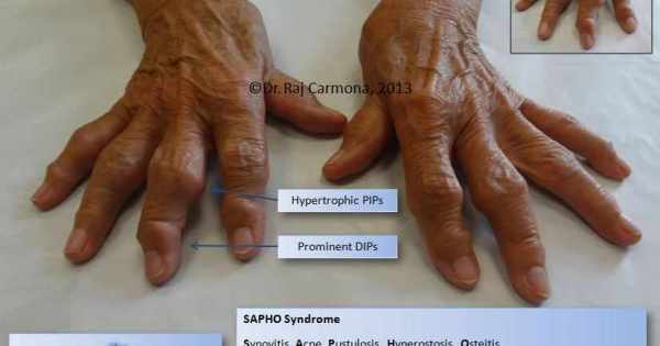 متلازمة سافو SAPHO متلازمة سافو SAPHO