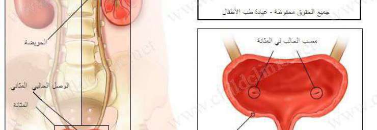 امراض الجهاز البولي عند الأطفال