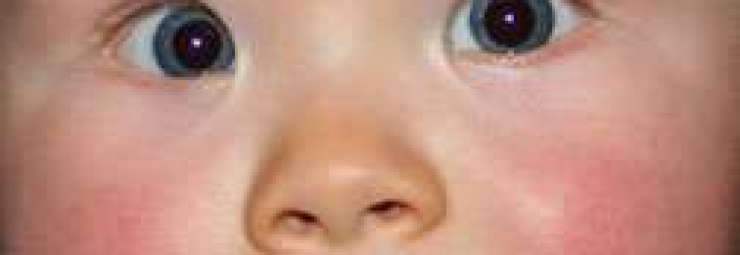 امراض العيون عند الاطفال