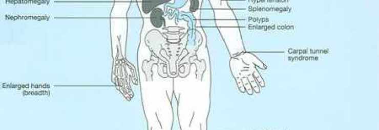 أعراض مرض ضخامة النهايات